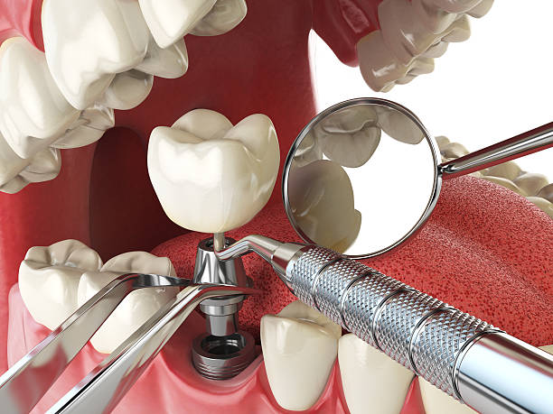 Best Emergency Root Canal Treatment in North Sioux City, SD